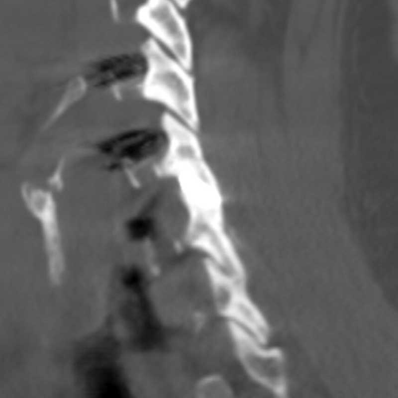 CAVUX® FFS - posterior cervical-fusion - sagittal CT with bridging bone