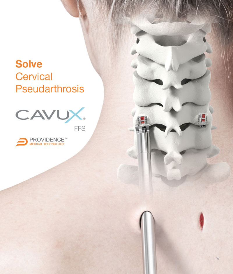 CAVUX® FFS shown with CORUS™ Spinal System-X.