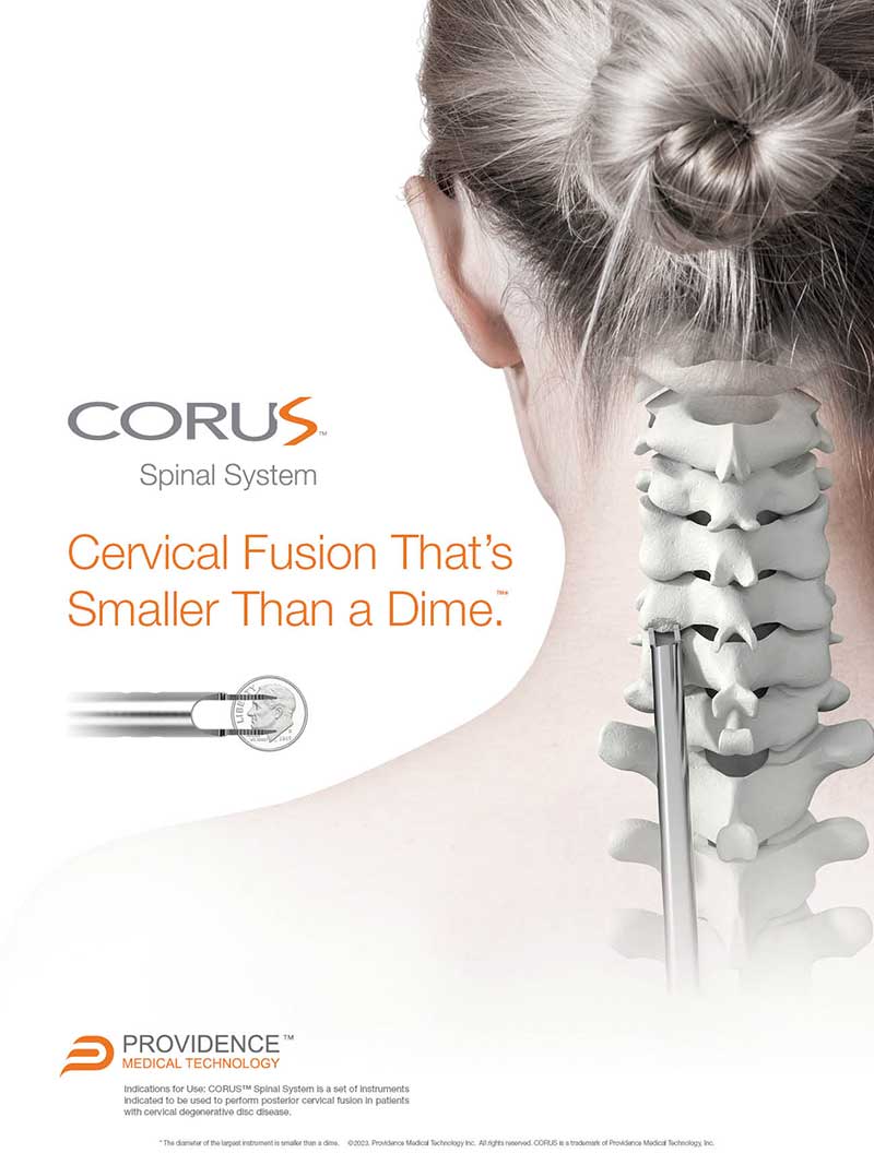 CORUS™ Spinal System - Posterior cervical fusion that's smaller than a dime