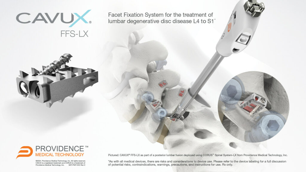 CAVUX FFS-LX has received FDA clearance for use in lumbar fusion