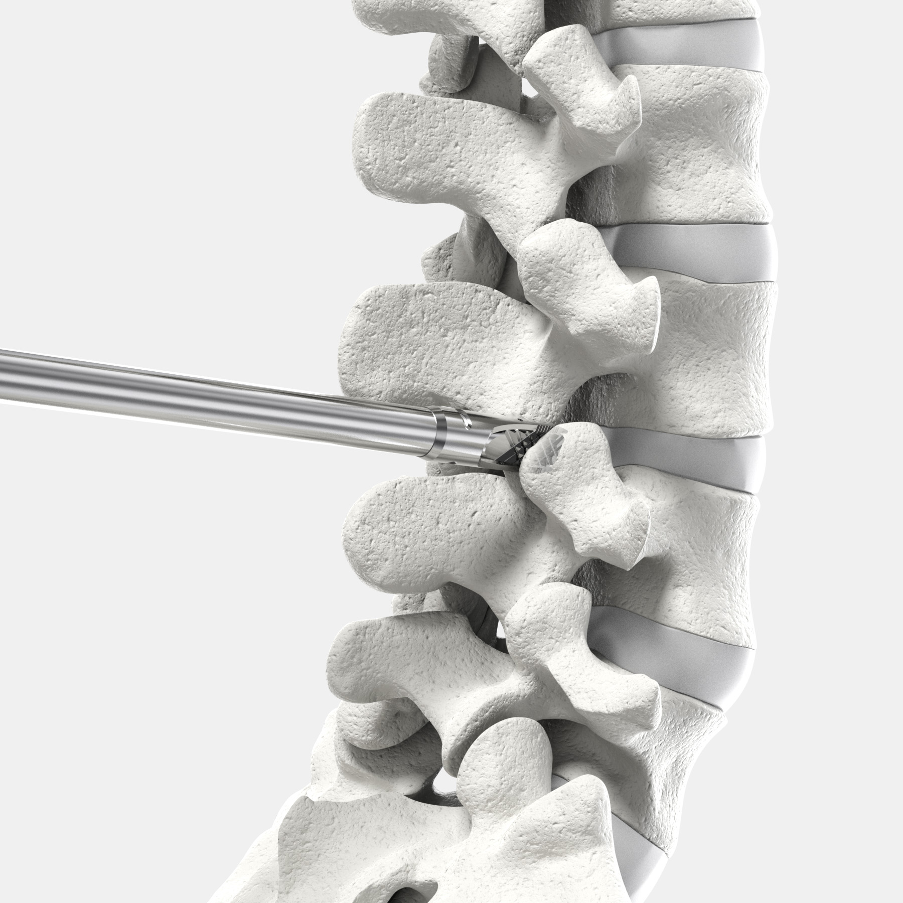 CORUS™ Spinal System-LX in a lumbar spine. Its Decortication Rasp provides thorough and precise bone preparation.