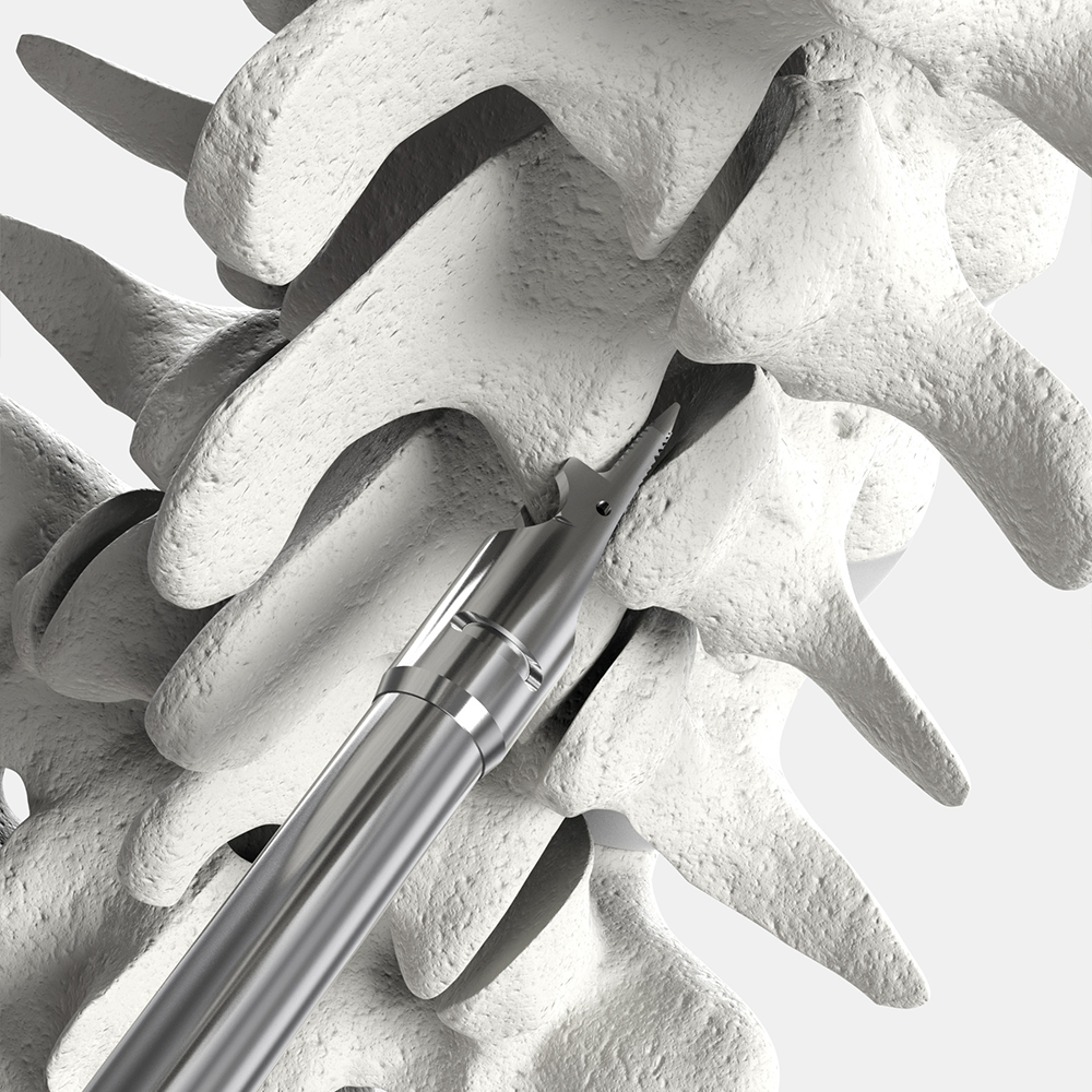 CORUS™ Spinal System-LX in a lumbar spine. Its positive stops designed for precise depth control and safety.