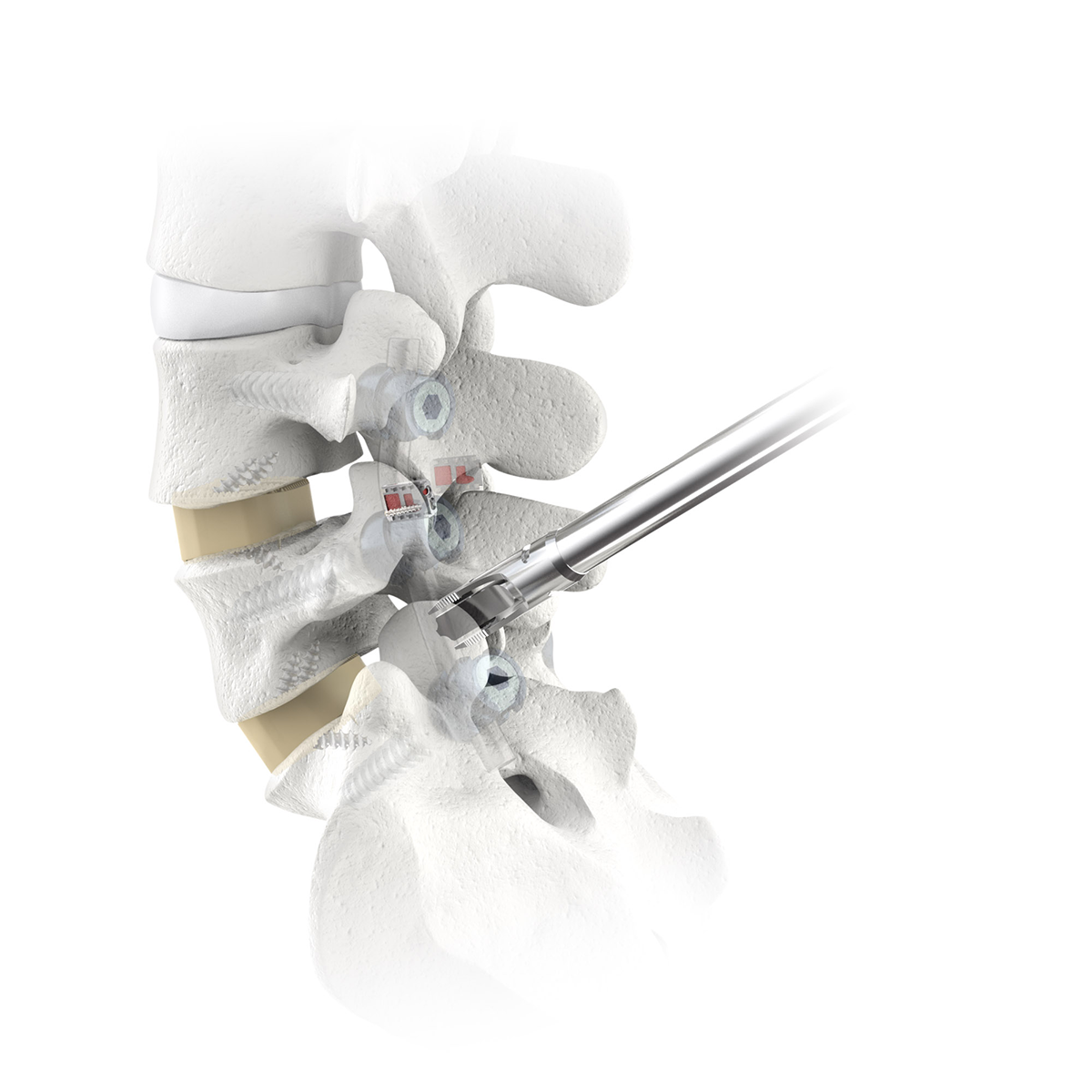 CORUS Spinal System-LX with CAVUX FFS-LX in lateral lumbar spine.
