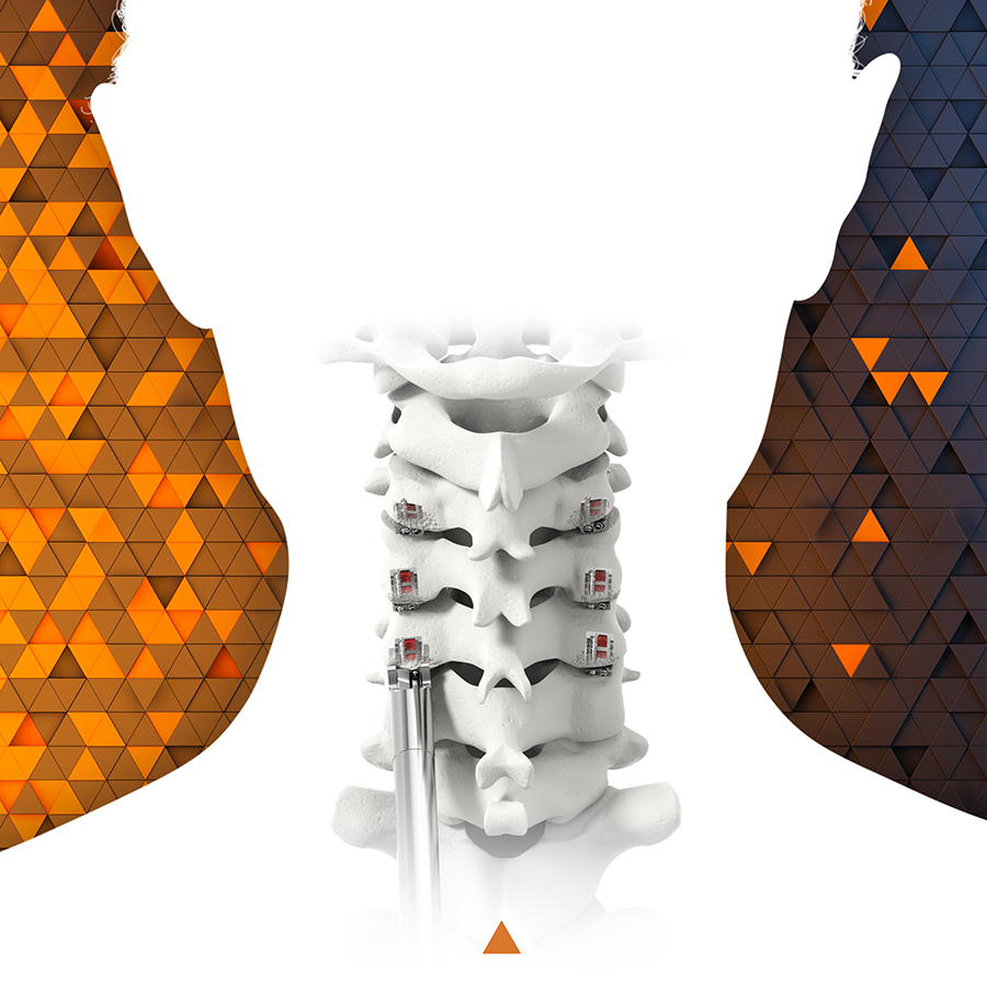 CORUS™ PCSS for circumferential cervical fusion up to 3 levels.