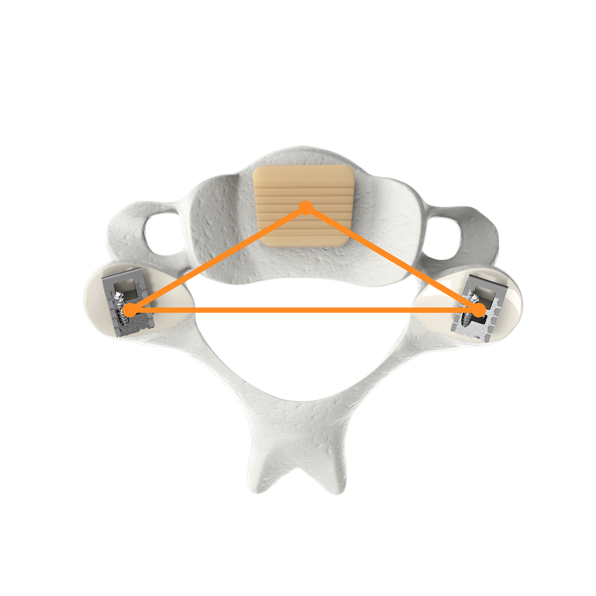 CORUS PCSS forms a Triforce of Stability to stabilize the cervical spine for fusion.