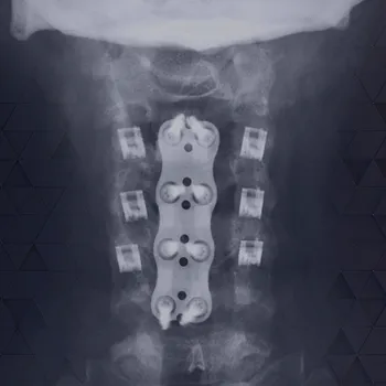 Tissue-sparing circumferential cervical fusion with CORUS PCSS