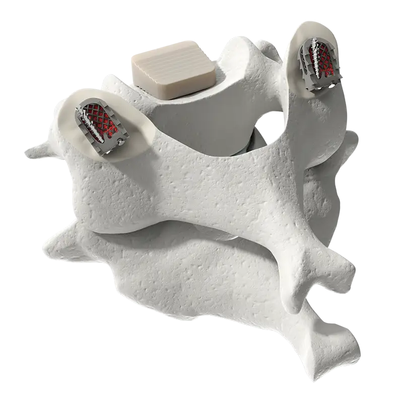 in addition to the anterior fusion, CORUS™ PCSS 3D devices are placed bilaterally in the facet joints to achieve circumferential cervical fusion (CCF).