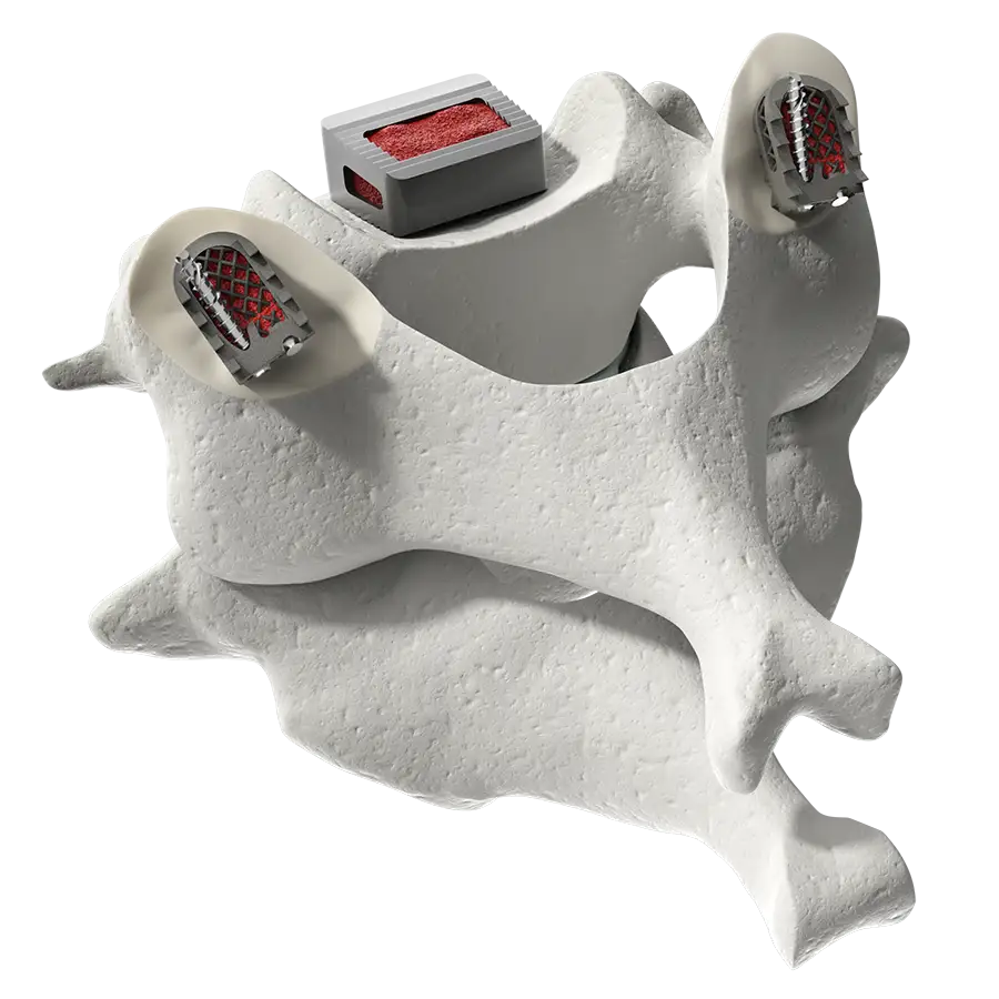 CORUS PCSS placed bilaterally in cervical facet joints, combined with an anterior titanium cervical cage